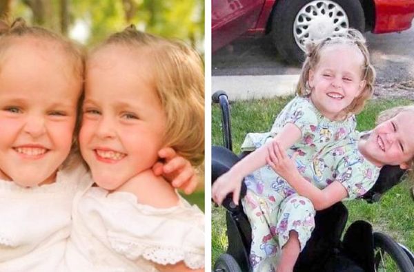 The Amazing Journey of Kendra and Malia Herrin, Siamese Twins