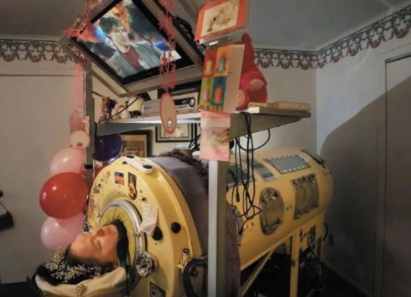 Woman Who Spent Life in Iron Lung Dies at 61